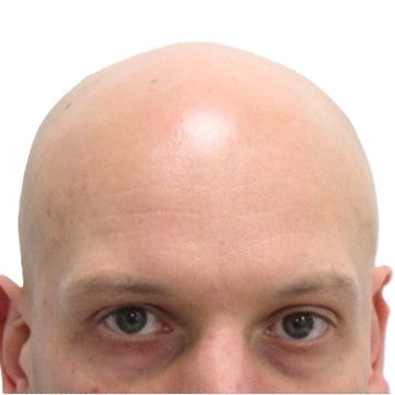 Close up of a bald scalp showing smooth skin and natural hairline area
