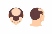 Full Head / Crown Coverage