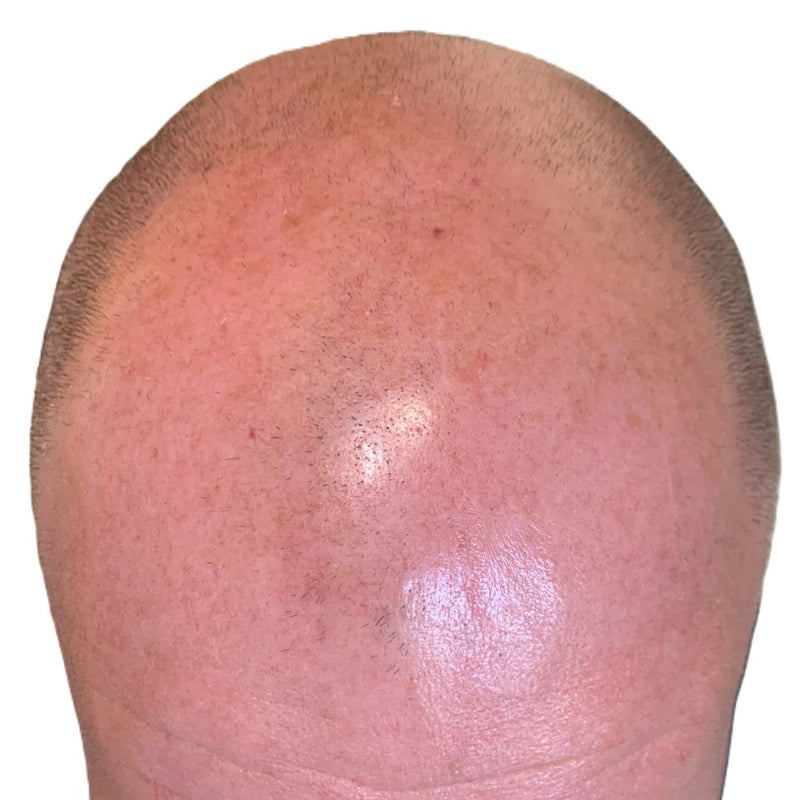 Close-up of a bald head with visible scalp texture on a white background