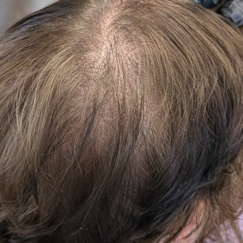 Top view of female crown showing visible scalp and thinning hair around the crown area before scalp micropigmentation treatment