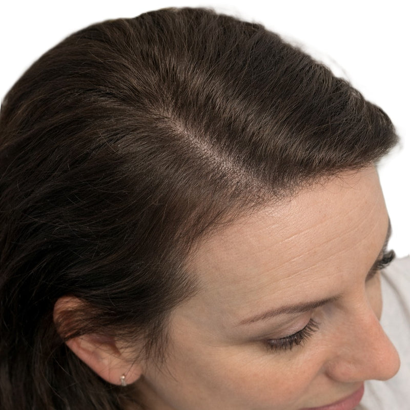 Side view of female head showing improved results after scalp micropigmentation treatment