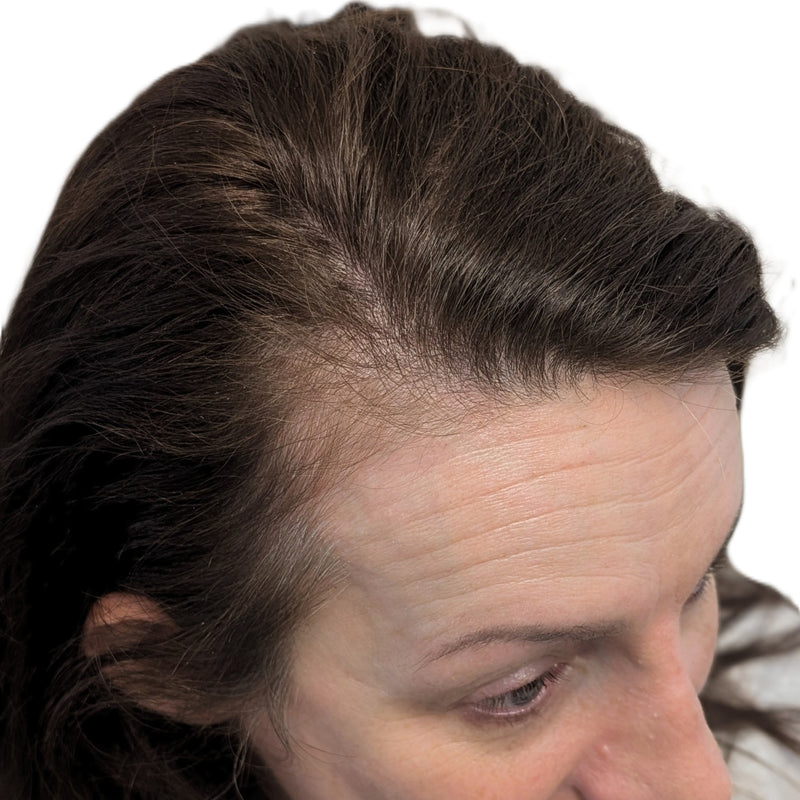 Side angle view of female head showing thinning hairline and reduced density at the front with visible scalp before scalp micropigmentation treatment