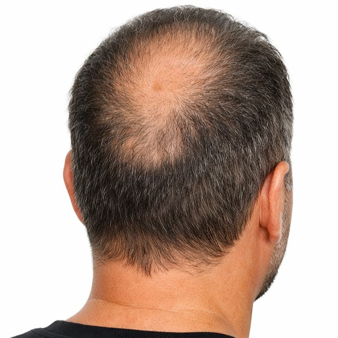 Back view of a man showing thinning hair and visible bald spot on the crown area of the scalp indicating male pattern hair loss