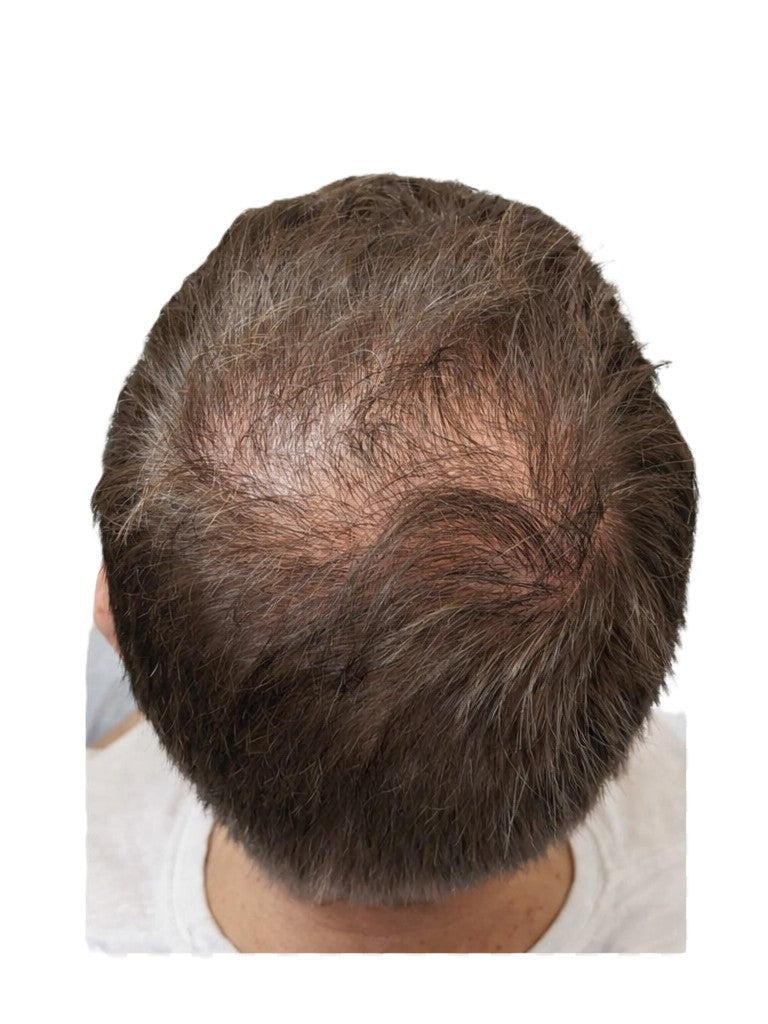 Top down view of a man showing visible thinning at the crown with sparse hair and exposed scalp before scalp micropigmentation treatment
