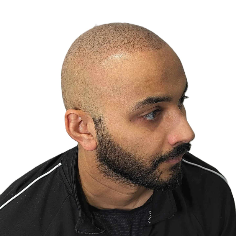Side profile of man with scalp micropigmentation showing clean and realistic hairline effect
