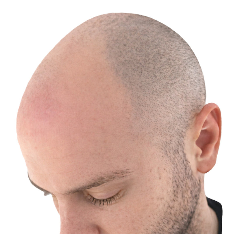 Scalp micropigmentation for bald head