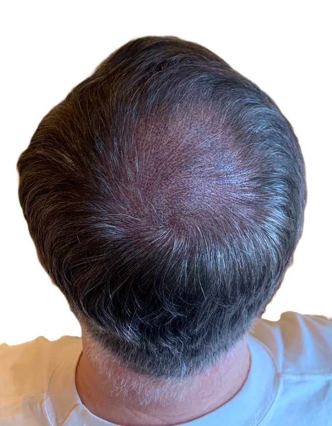 Back view of crown thinning after scalp micropigmentation