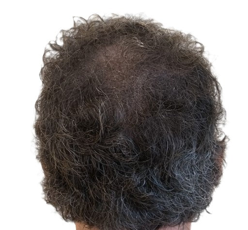 Scalp micropigmentation for crown thinning