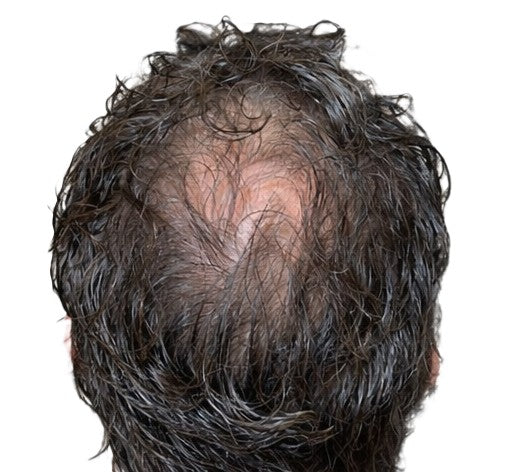 Scalp micropigmentation for crown thinning
