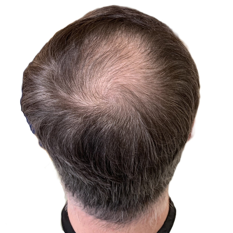 Top view of crown thinning before scalp micropigmentation