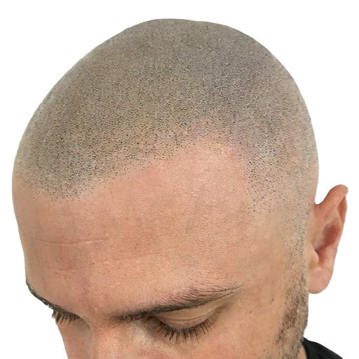 Scalp micropigmentation hairline result